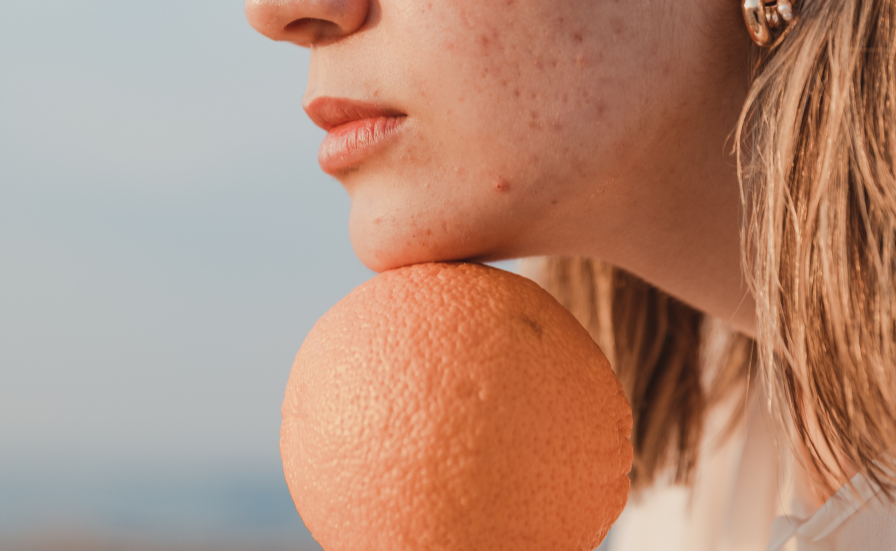 Best Diet for Acne: What to Eat (and Avoid) for Acne-Free Skin